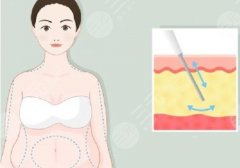 广医三院吸脂怎么样？医院技术大牛！案例多、反馈好
