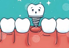 2025南京牙齿种植哪里好？分析了南京口腔、鼓楼等医院资料