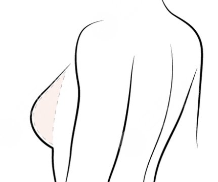 隆胸