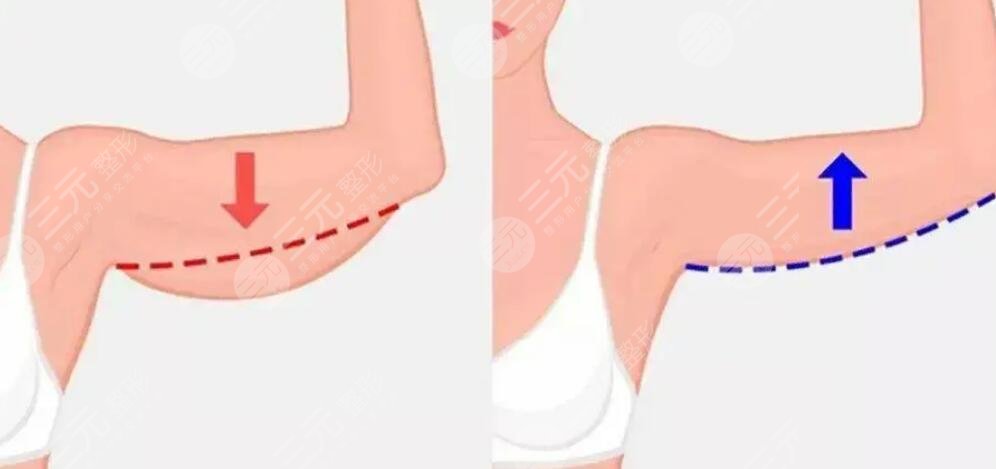 手臂吸脂