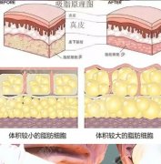 冯斌做面吸真的好吗？擅长的手术方式是什么？优势盘点