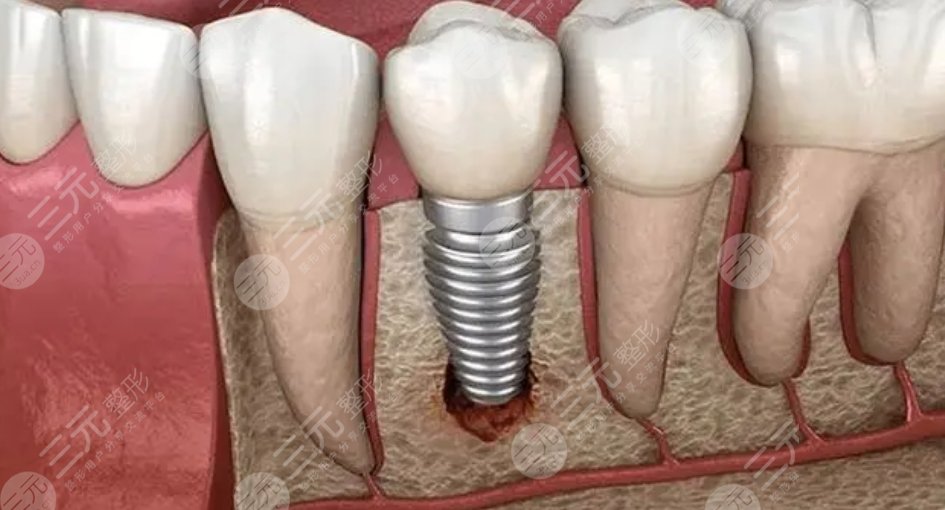 种植牙