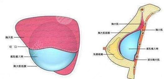 隆胸