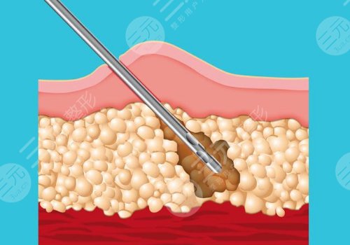 成都莱瑞拉医院是渠道医院吗