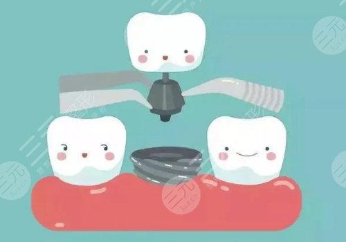 良乡医院种牙多少钱