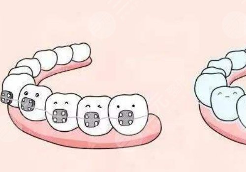 上海市口腔医院牙齿矫正价格