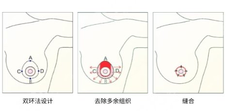 缩胸