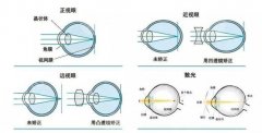 上海近视手术价格指南:从万元飞秒到4万晶体,你的“清晰视界”值多少? 上海近视手术价格指南:从万元飞秒到4万晶体,你的“清晰视界”值多少?