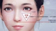 苹果肌填充的费用大概要多少钱呢?填充有哪些方式? 苹果肌填充的费用大概要多少钱呢?填充有哪些方式?