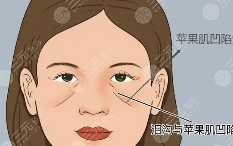 苹果肌填充动漫