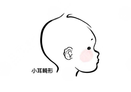 黄泽春医生做耳在造手术怎么样