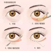 番禺区人民医院去眼袋怎么样?多少钱?“拆袋”实力测评! 番禺区人民医院去眼袋怎么样?多少钱?“拆袋”实力测评!