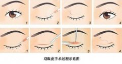 王树医生双眼皮怎么样?自然派掌门口碑实力分析! 王树医生双眼皮怎么样?自然派掌门口碑实力分析!