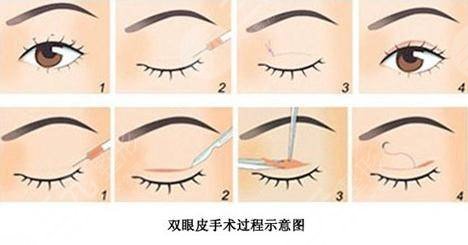 青岛割双眼皮