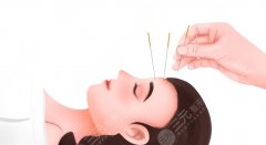 中医针灸能面部紧致提升吗?多少钱?戳进来看 中医针灸能面部紧致提升吗?多少钱?戳进来看