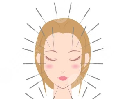 中医针灸能面部紧致提升