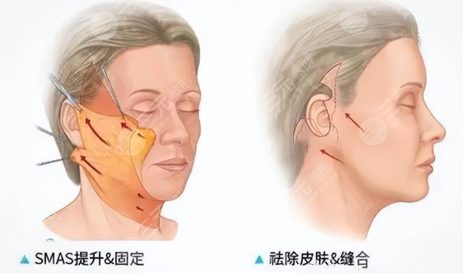 面部筋膜悬吊术=