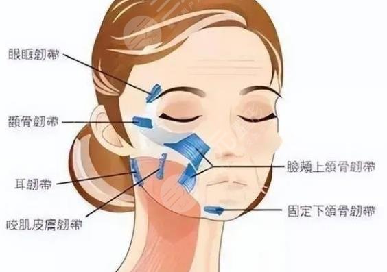面部筋膜悬吊术
