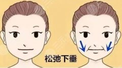 下颌缘提升是打哪个部位?那些人比较适合做呢? 下颌缘提升是打哪个部位?那些人比较适合做呢?