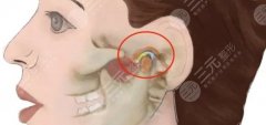 耳前韧带提升打哪里?如何重塑面部紧致感? 耳前韧带提升打哪里?如何重塑面部紧致感?