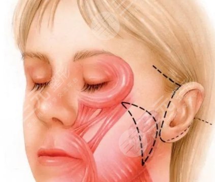 耳前韧带提升