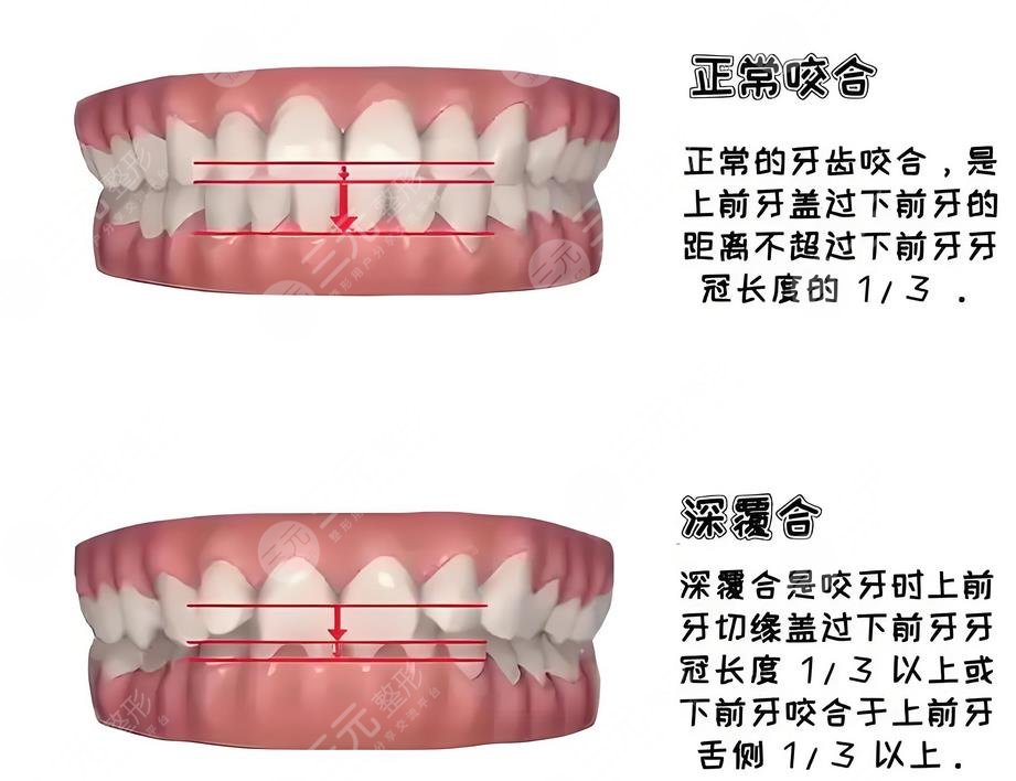 深覆合矫正到底是什么?