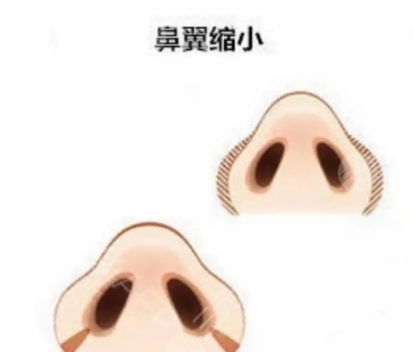 鼻翼缩小