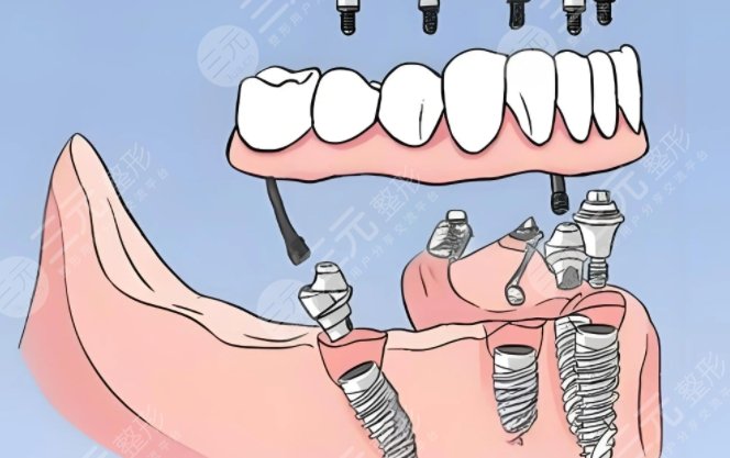 牙齿种植