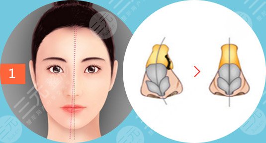 歪鼻矫正手术核心解析