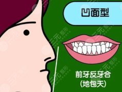 20岁地包天矫正需要多少钱？效果好不好？原理介绍