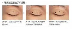 微创双眼皮和全切双眼皮的区别：一篇看懂选哪种