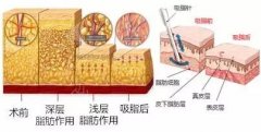 去双下巴选抽脂还是溶脂？一篇全解析让你告别“游泳圈”！