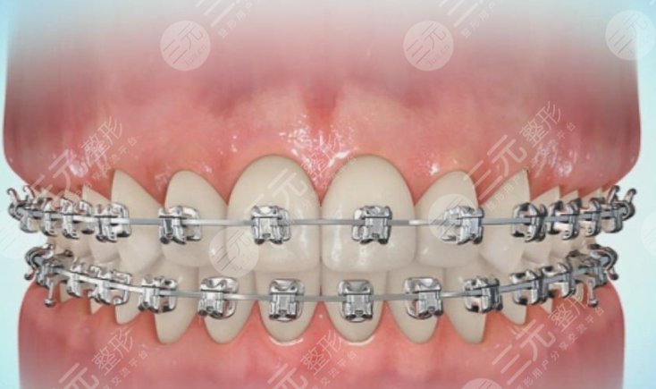 反颌矫正