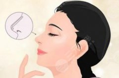 隆鼻假体软的好还是硬的好？那种材料效果更好维持时间更长