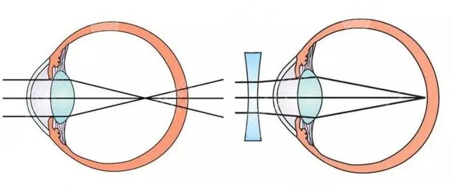 近视眼