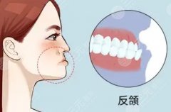 反颌怎么矫正？做矫正手术有风险吗？