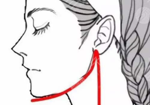 重庆华美下颌角磨骨