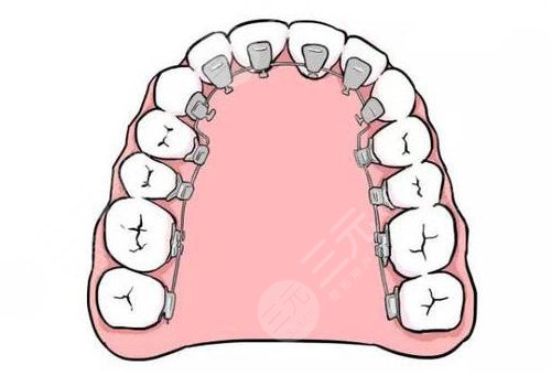 上海医大医院牙齿矫正费用