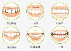 舌侧矫正和传统矫正哪个好？暑期正畸必看攻略！
