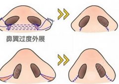 2025广州缩小鼻翼好的医院top名单更新，3家私立机构实测报告