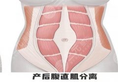 2025深圳首康医院腹直肌修复价格是多少?8000元左右起!附医院简介! 2025深圳首康医院腹直肌修复价格是多少?8000元左右起!附医院简介!