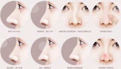 珠海鼻修复余传伟好还是周国伟好？鼻修复修罗场！附价格明细