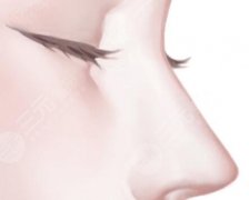 嗨体1.5的填充鼻基底能维持多久？揭晓维持时间_术后护理查看