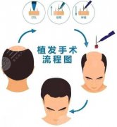 重庆唐森医院植发怎么样啊?李少雄技术专业、价格1万元左右起 重庆唐森医院植发怎么样啊?李少雄技术专业、价格1万元左右起