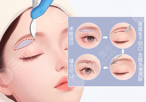 北京青蓝整形医院提眉