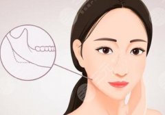 福建省立医院整形科杨宇医生做磨骨手术好吗？技术精湛|审美眼光在线！