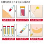 南京自体脂肪隆胸哪个医生厉害？谭谦、侯祚琼等5大专家测评！