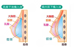 曼陀假体和傲诺拉假体如何？选择指南与注意事项公布