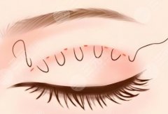 上海埋线双眼皮哪家好？实测这五家医院实力