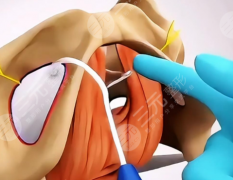3D束带紧缩手术治疗漏尿有用吗?真实情况这里给你说透 3D束带紧缩手术治疗漏尿有用吗?真实情况这里给你说透